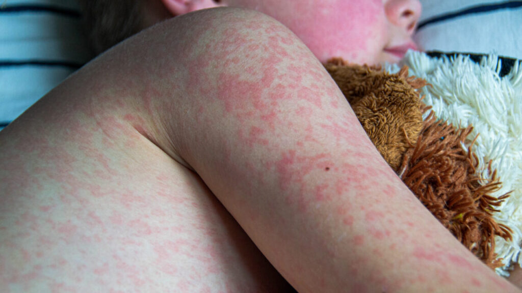 Texas measles outbreak reaches 90 cases; 9 cases in New Mexico