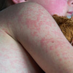 Texas measles outbreak reaches 90 cases; 9 cases in New Mexico