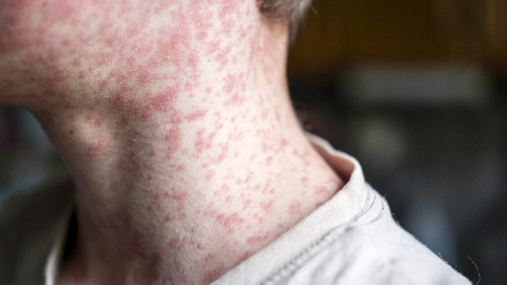 Measles outbreak in undervaccinated Texas area doubles—again