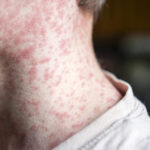 Measles outbreak in undervaccinated Texas area doubles—again