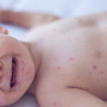 US measles outlook is so bad health experts call for updating vaccine guidance