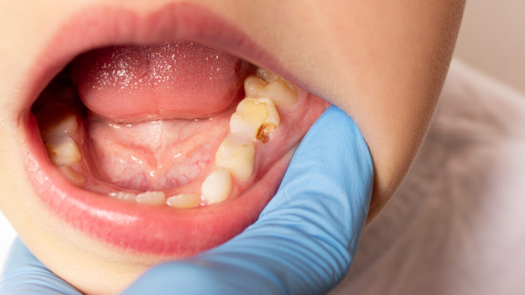 RFK Jr.’s fluoride ban would ruin 25 million kids’ teeth, cost $9.8 billion